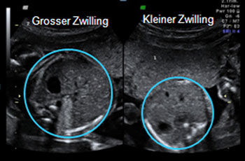 p zwillingsprobleme 02