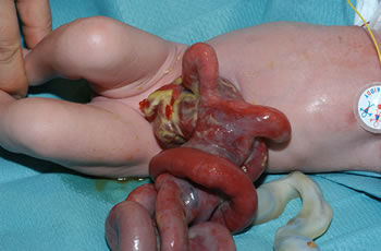 p gastroschisis problem 1