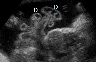 p gastroschisis problem 2