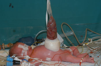 p gastroschisis problem 4