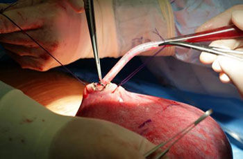 p spina bifida problem ch 3