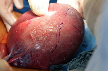 p spina bifida problem ch 2