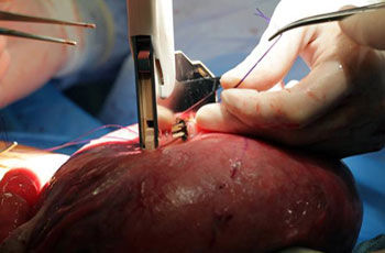 p spina bifida problem ch 4