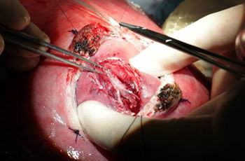 p spina bifida problem ch 7