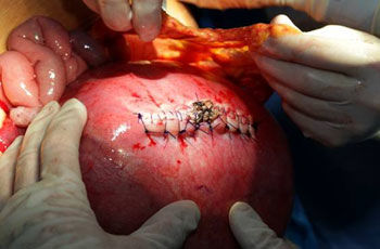 p spina bifida problem ch 10