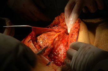 p spina bifida problem ch 11